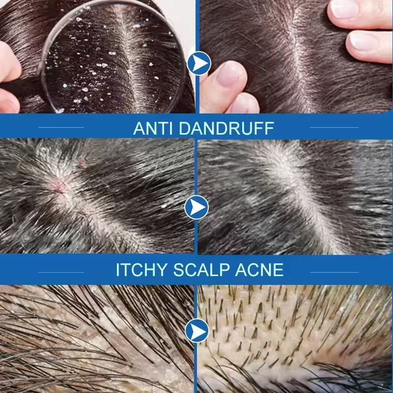Быстрое средство против перхот – обзор и цена Hair Care Dandruff