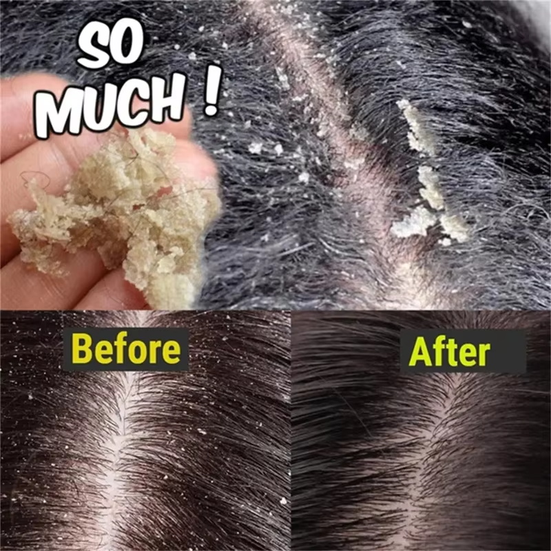 Быстрое средство против перхот – обзор и цена Hair Care Dandruff